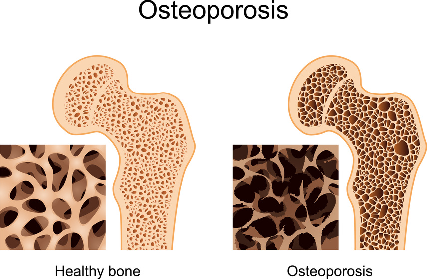 osteoporosis